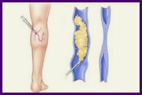 Sclerotherapy เป็นวิธีที่นิยมในการกำจัดเส้นเลือดขอดที่ขา
