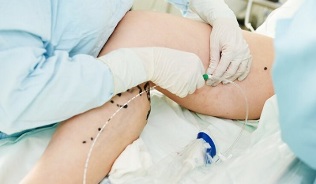 วิธีการรักษาเส้นเลือดขอดที่ขาในสตรี